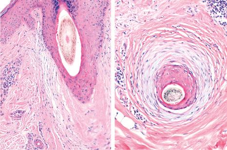 Fig. 22.137, Lichen planopilaris, vertical and horizontal sections: there is mucinous perifollicular fibroplasia.