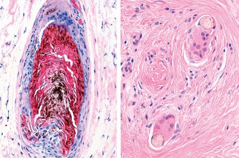 Fig. 22.138, Lichen planopilaris: there are numerous giant and epithelioid cells surrounding the free hair shafts in the dermis.