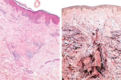 Fig. 22.139, Lichen planopilaris. Left : follicular scar extending from the epidermis to the deep dermis. Right : With the elastic stain loss of elastic fibers in triangular shape with the base toward the epidermis is observed. The follicular scarring shows condensation of elastic fibers with a vertical orientation.