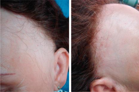 Fig. 22.140, Frontal fibrosing alopecia: bandlike recession of the frontotemporal hairline associated with lateral eyebrow thinning. Note the solitary hairs in the frontal scalp.