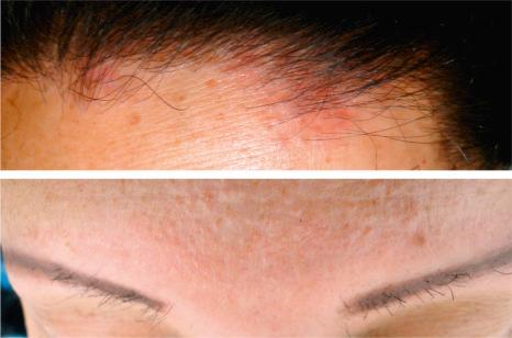 Fig. 22.141, Frontal fibrosing alopecia. Above : there is hair loss on the frontal scalp. The skin shows perifollicular erythema. Below : the skin appears mildly scarred with prominence of the follicles and inflammation. There is almost total absence of eyebrows.