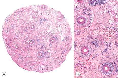 Fig. 22.142, Frontal fibrosing alopecia, horizontal section. ( A ) In this scanning magnification, there is absence of sebaceous glands, loss of hair follicles, and perifollicular fibrosis. ( B ) Lichenoid interface dermatitis of the outer root sheath, with vacuolar change, lymphocytic inflammation and perifollicular lamellar fibrosis.