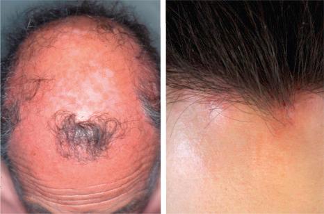 Fig. 22.144, Lichen planopilaris, fibrosing alopecia in a pattern distribution. Left : note the absence of follicular orifices with pigment alteration in the pattern of androgenetic alopecia. Right : a male patient with androgenetic alopecia and follicular inflammation.
