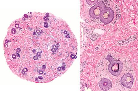 Fig. 22.145, Lichen planopilaris, fibrosing alopecia in a pattern distribution: horizontal section. Extensive miniaturization with loss of sebaceous glands, discrete fibrosis and perifollicular lymphocyte inflammation.