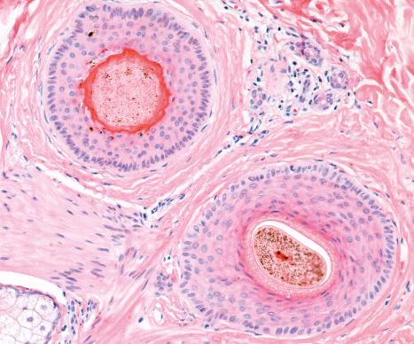 Fig. 22.27, Terminal hair follicles in catagen and anagen, horizontal sections: note the differences between a catagen follicle ( top left ) with trichilemmal keratin surrounding the hair shaft, apoptotic cells and loss of melanin and an anagen, heavily pigmented terminal follicle (inferior).