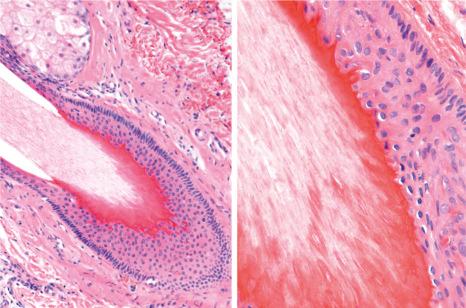 Fig. 22.29, Terminal hair follicles in late catagen: the outer root sheath has been lost and the keratinization is of trichilemmal type.