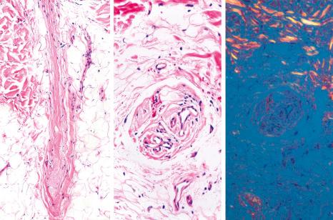 Fig. 22.34, Follicular stella: note the fibrovascular stella composed of collagen fibers, fibroblasts, and blood vessels in vertical and horizontal sections. The elastotic material is apparent between the collagen fibers. With polarized light, there is no birefringence of the follicular stellae.