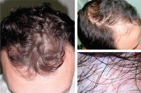 Fig. 22.35, Male androgenetic alopecia: this patient shows well-established male pattern baldness with bifrontal hair line recession and hair loss on the scalp vertex. In the dermoscopic image on the right, note the difference in caliber between hair follicles.