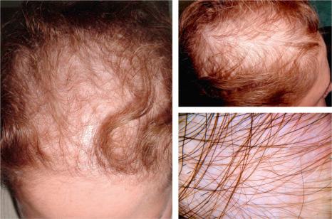 Fig. 22.36, Female pattern hair loss: this example shows a typical example with parietal and posterior frontal hair loss. Note the sparing of the frontal hairline. In the dermoscopic image on the right lower panel, note the hair loss due to extensive miniaturization on a noninflammatory background.