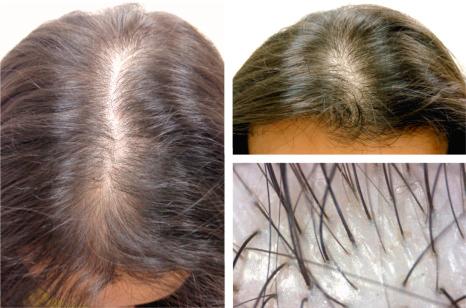 Fig. 22.37, Female pattern hair loss in a girl: early hair loss is observed with widening of the interparietal line. In the dermoscopic image on the right lower panel, note a tendency to miniaturization with hair follicles of different calibers.