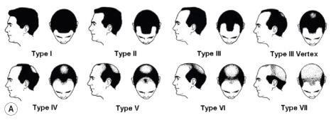 Fig. 22.38, ( A ) Hamilton-Norwood classification of male pattern androgenetic alopecia ( top ).