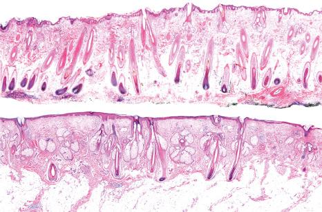 Fig. 22.39, Androgenetic alopecia. Vertical sections. In the top panel normal scalp with numerous terminal hair follicles extending into the deep subcutaneous fat. In the lower panel, note a scalp biopsy from a patient with advanced androgenic alopecia. Barely visible, are a few thin follicles which only just reach the limit between the dermis and the subcutaneous tissue.