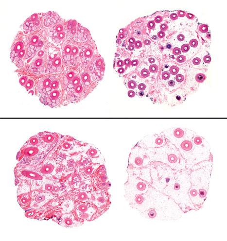 Fig. 22.40, Androgenetic alopecia, horizontal sections: in the upper panel, a biopsy of normal scalp taken from the occipital area. There are numerous follicular units formed by follicles of uniform size. Below are sections from an area of frontal alopecia with more than half of the follicles miniaturized (vellus) or in the process of miniaturization. The follicular units have disappeared and in the subcutaneous fat there are numerous stellae.