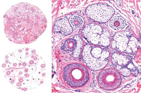 Fig. 22.43, Androgenetic alopecia, horizontal sections: ( left ) this is a scalp biopsy taken from the interparietal area. In the superficial section ( top ), there are numerous miniaturized hair follicles. In the section at the level of the subcutaneous tissue ( bottom ), many of the follicles have been replaced by follicular stellae (S); ( right ) follicular units with two terminal follicles at the bottom and three miniaturized follicles at the top.