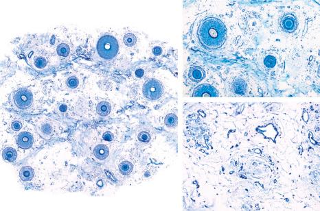 Fig. 22.44, Androgenetic alopecia: in this more advanced example, the follicular density is greatly reduced with many miniaturized hair follicles ( left ) and numerous stellae ( right ). Toluidine blue stain.