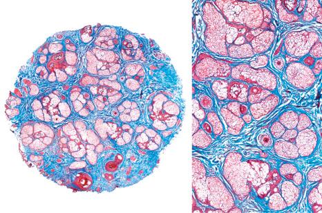 Fig. 22.45, Androgenetic alopecia: almost all hair follicles are miniaturized and the sebaceous glands appear prominent. The hair shafts are barely visible. Masson trichrome stain.