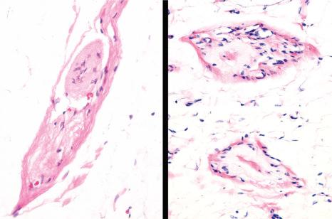 Fig. 22.49, Arao-Perkins bodies, in vertical ( left ) and horizontal ( right ) sections. Note the collagenous and elastotic material deposited in the center of the follicular stellae.