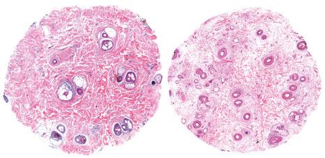 Fig. 22.50, Androgenetic alopecia, final stage: follicular units and miniaturized hair follicles are rare. In this advanced stage, connective tissue has almost completely replaced follicular structures and the appearance resembles a scarring alopecia. In the section on the right, upper part, a syringoma-like proliferation of sweat ducts is observed.