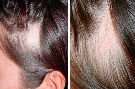 Fig. 22.52, Triangular alopecia: note the characteristic triangular patch of alopecia. In the right panel, a close-up view shows absence of inflammatory changes.