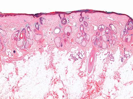 Fig. 22.53, Triangular alopecia: this biopsy is taken from the edge of a lesion. One terminal hair follicle is present on the right side of the field (unaffected scalp). There are no stellae or inflammatory cells.