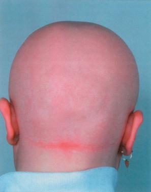 Fig. 22.56, Alopecia areata totalis: in this patient, there is complete loss of scalp hair.