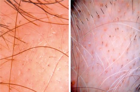 Fig. 22.57, Alopecia areata dermoscopy: note that the follicular density is normal and the opening of the follicles have not been lost. There are some miniaturized hair follicles and an exclamation mark hair. On the right panel, yellow dots are observed. The gray hairs have persisted despite the loss of the pigmented hair. There are also some exclamation mark hairs.