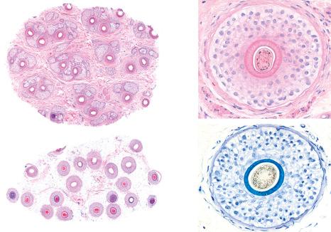 Fig. 22.6, Normal hair biopsy: horizontal section. On the left, all the hair follicles are visible at scanning magnification. On the right, all components of the hair follicle are seen in horizontal sections stained with H&E and toluidine blue.