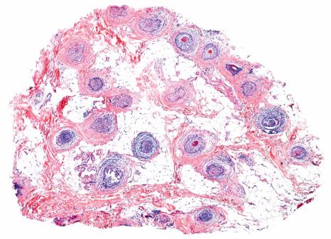 Fig. 22.59, Alopecia areata: Horizontal section displays a near normal density of hair follicles; some of the follicles on the left upper side are in catagen and telogen.