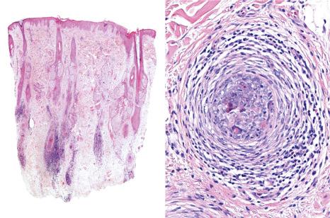 Fig. 22.61, Alopecia areata: vertical and horizontal sections of catagen-telogen hair bulbs. The inflammatory infiltrate is still present in the telogen remnants.