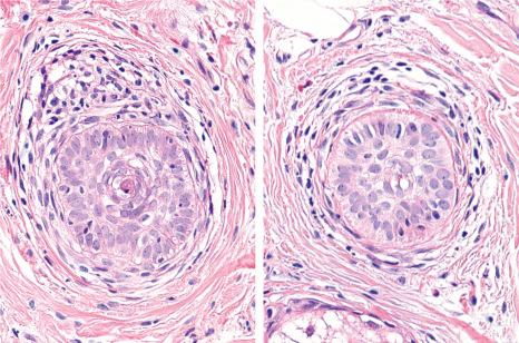 Fig. 22.63, Alopecia areata incognita: follicles in telogen. The hair follicle on the right displays features of a follicle in nanogen. There is a lymphocytic infiltrate associated with eosinophils and masts cells.