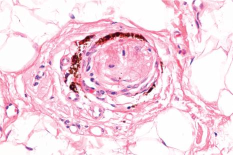 Fig. 22.66, Alopecia areata, follicular stella. The lymphocytes are highlighted by immunohistochemistry (CD3).