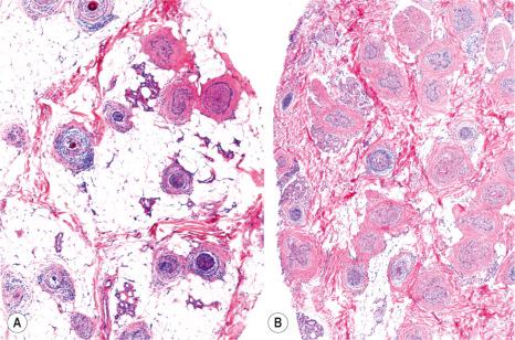 Fig. 22.69, ( A , B ) Alopecia areata, late stage: there is a remarkable increase in catagen/telogen follicles, and a sparse peribulbar lymphocytic infiltrate with formation of stellae.