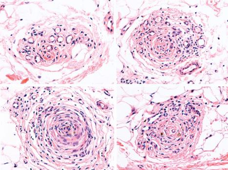 Fig. 22.71, Alopecia areata: different images of follicular stellae infiltrated by lymphocytes.