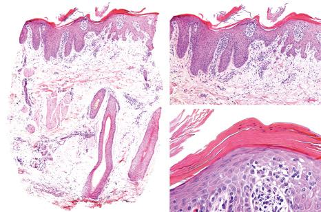 Fig. 22.73, Psoriasis. On the left the loss of sebaceous glands and follicular units is evident. On the right panel epidermal psoriatic changes including elongation of the rete ridges, hyperkeratosis, parakeratosis, hypogranulosis and corneal neutrophils.