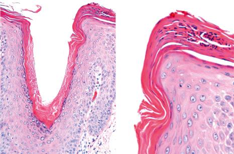 Fig. 22.74, Psoriasis of the scalp with changes simulating of seborrheic dermatitis. There is hyperkeratosis and parakeratosis with collections of neutrophils, more pronounced at the lip of the follicular ostium.