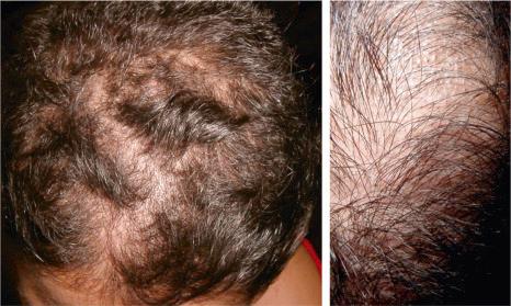 Fig. 22.75, Trichotillomania: mild involvement with very patchy hair loss.