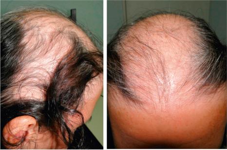 Fig. 22.76, Trichotillomania: severely affected young patient, with much more obvious and extensive hair loss with a bizarre pattern.