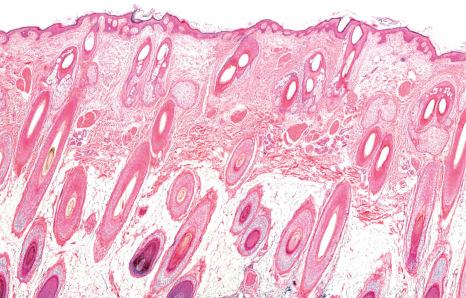 Fig. 22.8, Scalp biopsy: in this vertical section, no whole hair follicles are seen. Since they are all incomplete, additional sections are required to obtain an acceptable three-dimensional reconstruction.