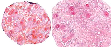 Fig. 22.80, Trichotillomania: in addition to residual anagen and telogen follicles, there are conspicuous catagen follicles with a bright eosinophilic center. No significant inflammation is seen.