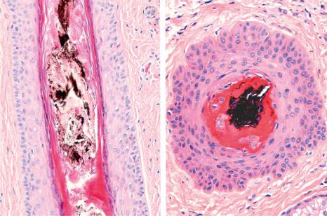 Fig. 22.81, Trichotillomania: note infundibular dilation with a pigment cast.