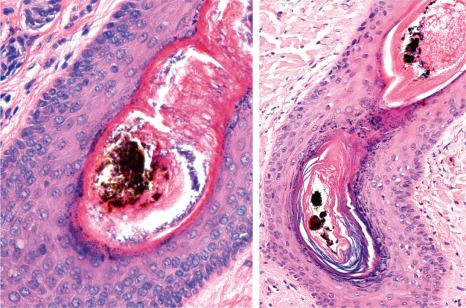 Fig. 22.82, Trichotillomania: there is infundibular dilatation, irregularity in the thickness of the inner root sheath, marked hyperkeratosis, and a pigmented cast.