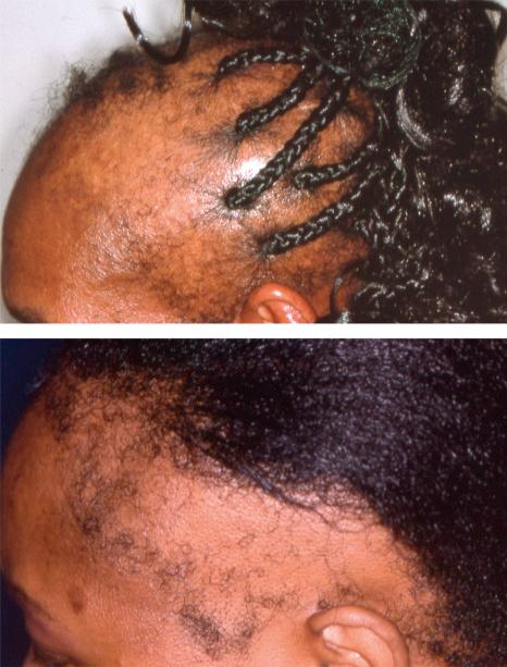 Fig. 22.86, Traction alopecia: prolonged traction for extended periods of time results in severe frontal hair loss. Pronounced changes are observed.