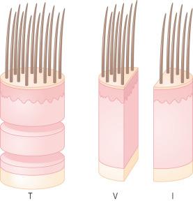 Fig. 22.9, Hair biopsy, transversal (T) and vertical (V) sections: ideally, two biopsies should be obtained. One of them is sectioned horizontally at different levels and the second can be vertically divided in two halves, one for routine histology and the other for immunofluorescence (I), electron microscopy, cultures and other techniques. Vertical sections are useful in cases that do not require comparison or follicle quantification; for example, in scarring alopecias. This type of sections must not be used in nonscarring alopecias, electron microscopy, cultures and other techniques. Vertical sections are useful in cases that do not require comparison or follicle quantification; for example, in scarring alopecias. This type of sections must not be used in nonscarring alopecias.