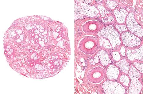 Fig. 22.90, Senile alopecia: there is a subtle decrease in the number of hair follicles and follicular units with preservation of the ratios between the number of terminal and vellus hair follicles and the hair follicles in anagen and telogen. There is an apparent increase in the amount of connective tissue between the follicular units which should not be confused with a scarring alopecia.