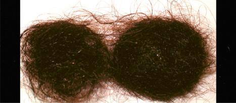 Fig. 22.93, Telogen effluvium; daily hair shedding count: during 10 days the patient has collected the hair she has shed. Despite the amount of hair loss there are no localized areas of hair loss.