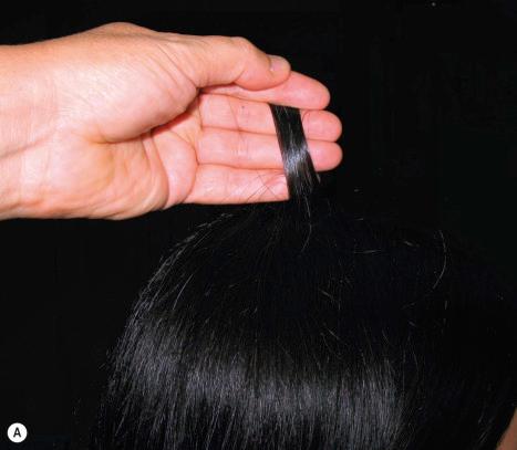 Fig. 22.94, Hair-pull test: ( A ) Take 20 to 30 hairs between the fingers and gently pull. The only hairs one should obtain are those in telogen; usually 10% of the total hairs, or 2 or 3 of the 30 pulled. Those that are in anagen remain adhered to the scalp. When more hair shafts are obtained from each pull, this suggests hair disease (telogen effluvium). ( B ) The hairs in telogen are usually recognizable because of their club shape.