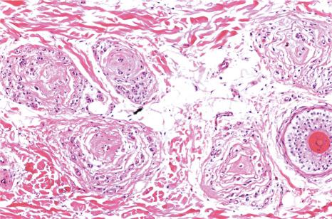 Fig. 22.97, Follicular stellae: five stellae corresponding to telogen follicles that have involuted. To the right a miniaturized hair follicle.