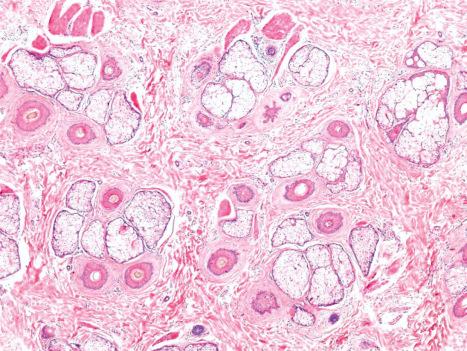 Fig. 22.98, Telogen effluvium and androgenetic alopecia: normal numbers of follicular units and hair follicles are present with increased numbers of telogen and miniaturized hair follicles.