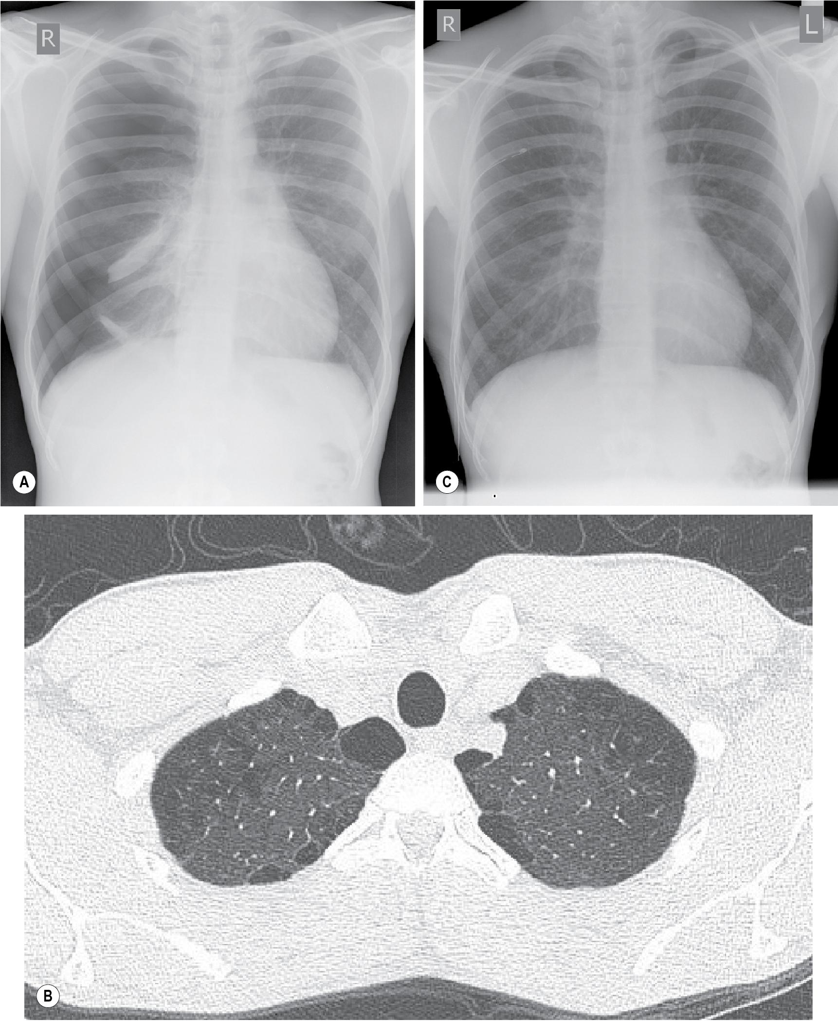 • Fig. 30.5, (A) Spontaneous pneumothorax with almost complete collapse of the right lung. (B) Computed tomography scan of the lung apices in the same patient showing multiple lung blebs. (C) The pneumothorax has been treated by the insertion of a chest drain, with complete reexpansion of the lung.