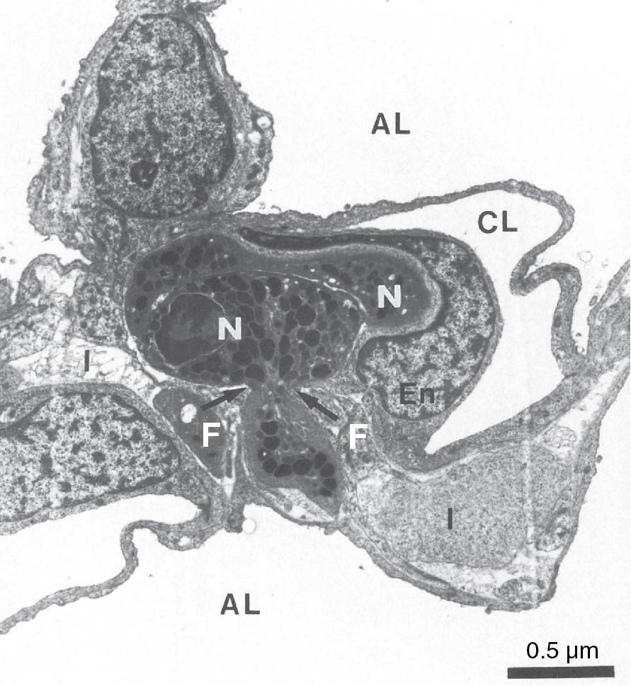 • Fig. 30.3, Neutrophil emigration in rabbit lung during streptococcal pneumonia. This electron micrograph shows that the neutrophils (N) , which are normally the same diameter as a pulmonary capillary, are elongated, so leaving capillary lumen (CL) partly patent. These neutrophils have already emigrated from the capillary lumen across the endothelium ( En ), and one is now passing into the interstitium (I) through a small hole in the capillary basement membrane ( arrows ). The pseudopod of the neutrophil is in close contact with fibroblasts (F) , which may be guiding the neutrophil through the defect in the basement membrane. AL , Alveolar lumen.